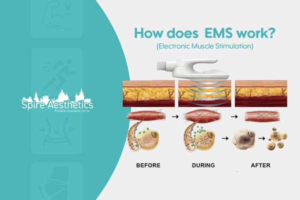 EMS treatment for post pregnancy weight loss treatment Amersham