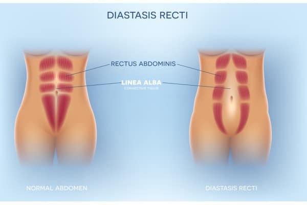 What Non-Surgical Options Are Available for Diastasis Recti Amersham?