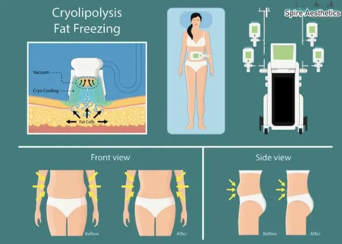 Fat freezing treatment Amersham benefits for competitions to remove stubborn fat deposits.