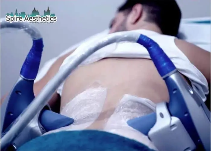 Man having fat freezing treatment done on love handles before a competitions Amersham to create a sculpted look.