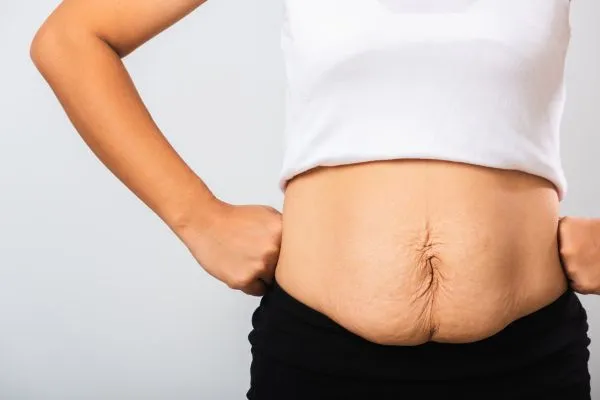 Image of a woman's stomach after weight loss with sagging skin following a gastric band Amersham
