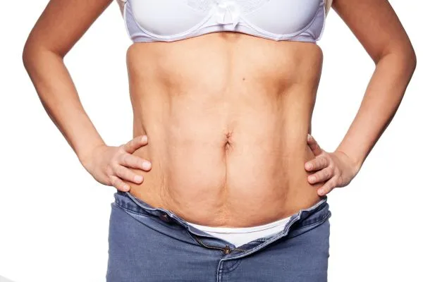 sagging skin on woman's stomach after weight loss injections Amersham