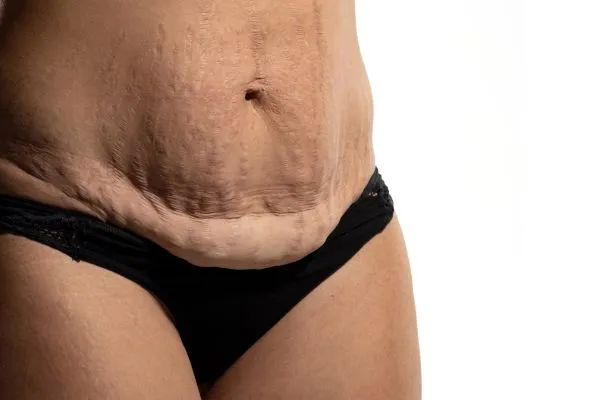 Image of womans stomach after weight loss injections Amersham showing saggy skin
