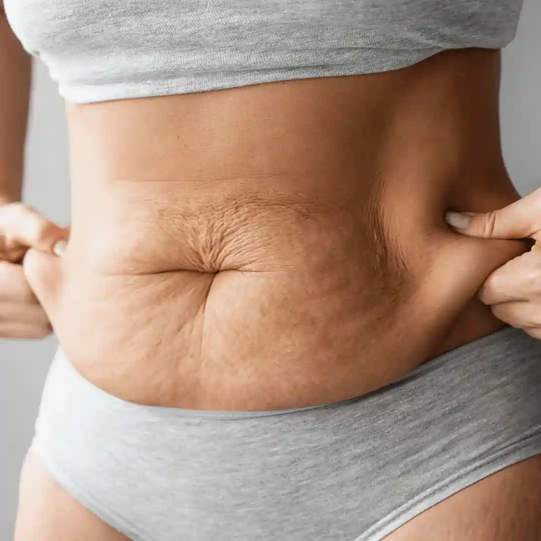 Is It Normal to Have Loose Skin After Pregnancy Amersham?