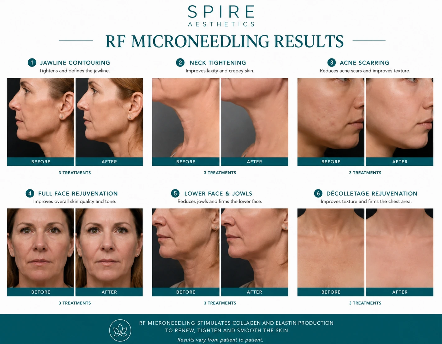 RF Microneedling Skin tightening Amersham results