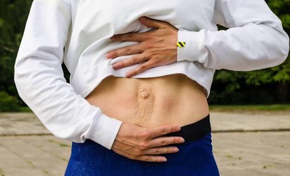 When Could Diastasis Recti Be the Missing Piece of the Puzzle Amersham?
