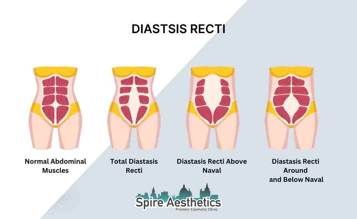 Is Non-Surgical Diastasis Recti Treatment Right for You? Common Concerns Answered Amersham